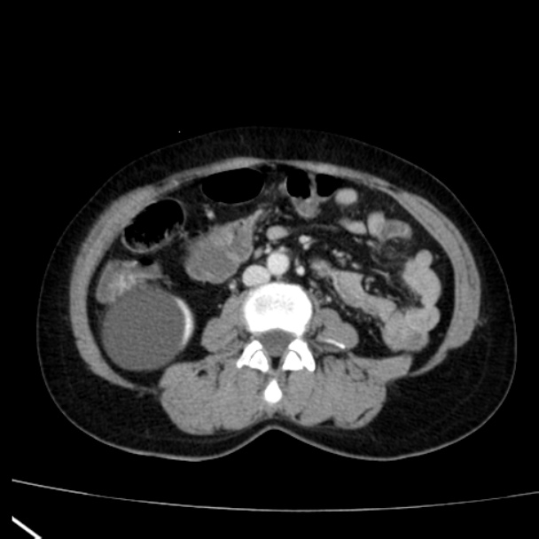 Bosniak renal cyst - type I (Radiopaedia 27479-27675 C 49).jpg