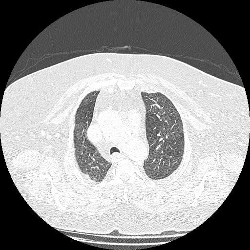 Bovine aortic arch - right internal mammary vein drains into the superior vena cava (Radiopaedia 63296-71875 Axial lung window 40).jpg