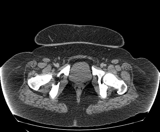 Bowel and splenic infarcts in acute lymphocytic leukemia (Radiopaedia 61055-68913 A 122).jpg