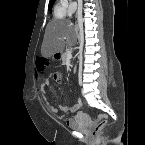 Bowel and splenic infarcts in acute lymphocytic leukemia (Radiopaedia 61055-68915 C 35).jpg