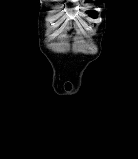 Bowel obstruction from colon carcinoma (Radiopaedia 22995-23028 C 1).jpg