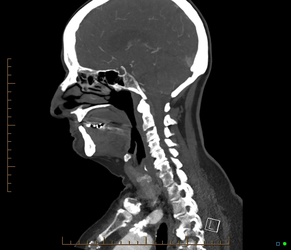 Brachiocephalic trunk stenosis (Radiopaedia 87242-103519 C 36).jpg