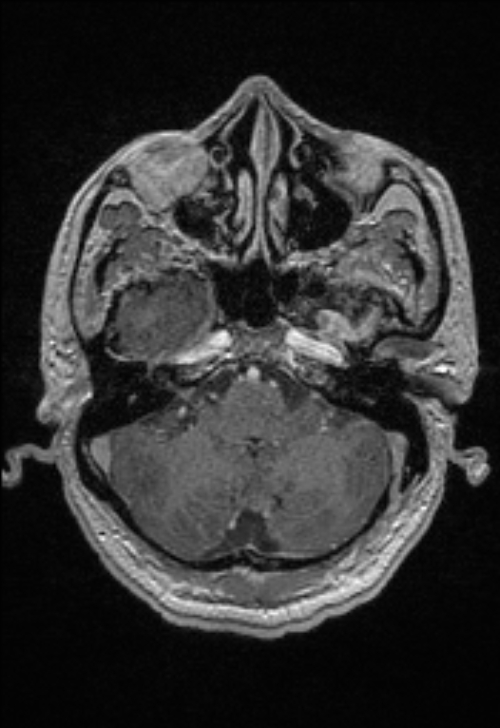 Brain abscess with ventriculitis (Radiopaedia 85703-101495 Axial T1 C+ 44).jpg