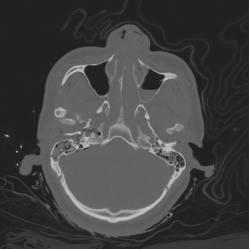 Brain contusions, internal carotid artery dissection and base of skull fracture (Radiopaedia 34089-35339 Axial bone window 51).png