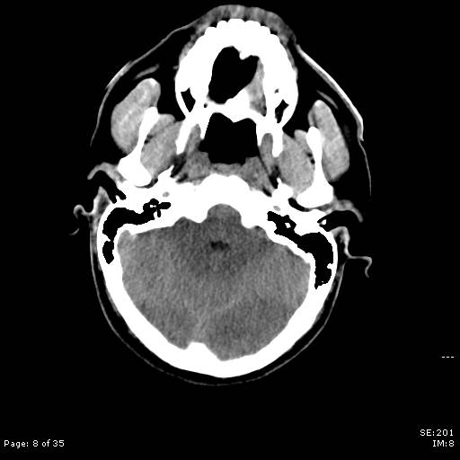 File:Brain death after motor vehicle collision (Radiopaedia 88470-105114 Axial non-contrast 8).jpg