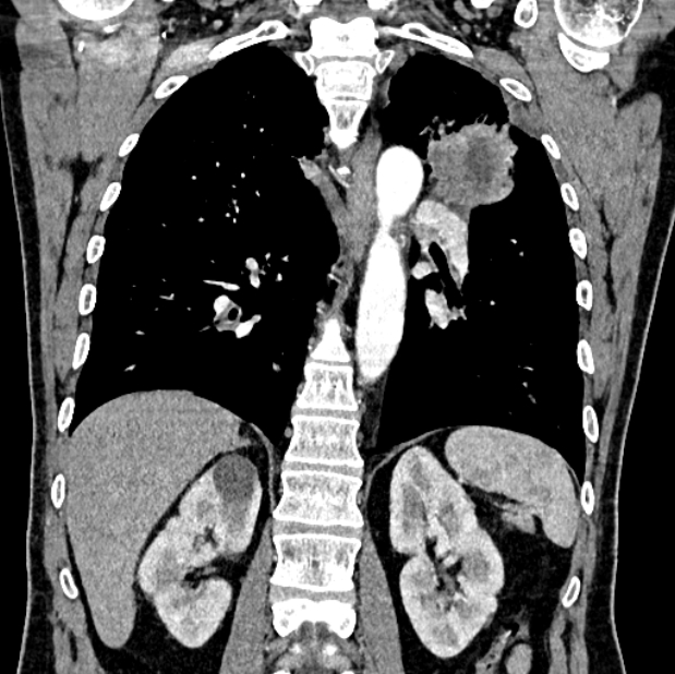 Brain metastases - lung cancer primary (Radiopaedia 75060-86116 C+ arterial phase 44).jpg