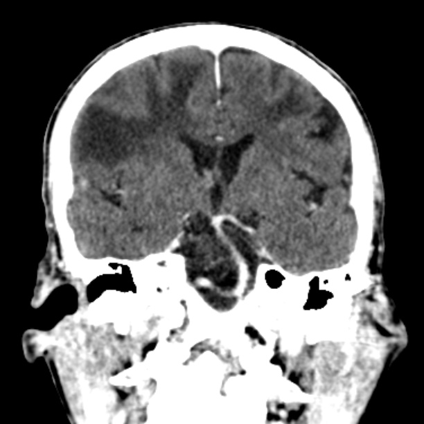 Brain metastases from lung cancer (Radiopaedia 27849-28092 Coronal C+ delayed 32).jpg
