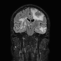 Brain metastases from lung cancer (Radiopaedia 83839-99028 Coronal FLAIR 40).jpg