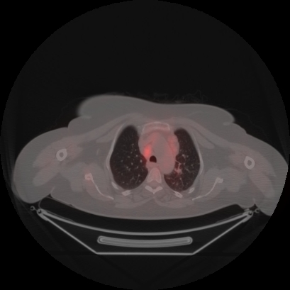Brain metastasis (Radiopaedia 89847-106962 Axial lung window 13).jpg