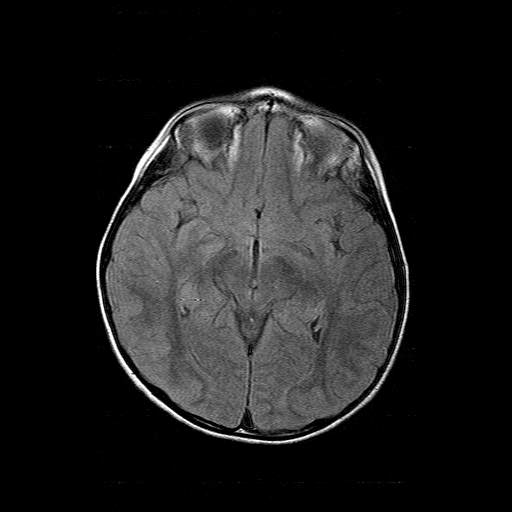 File:Brainstem ganglioglioma (Radiopaedia 10763-11224 Axial FLAIR 11).jpg