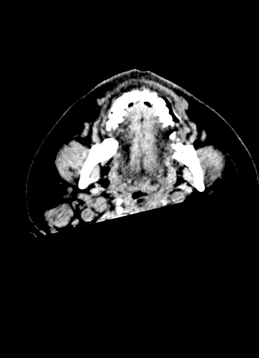 Brainstem hemorrhage (Radiopaedia 81294-94976 Axial non-contrast 78).jpg