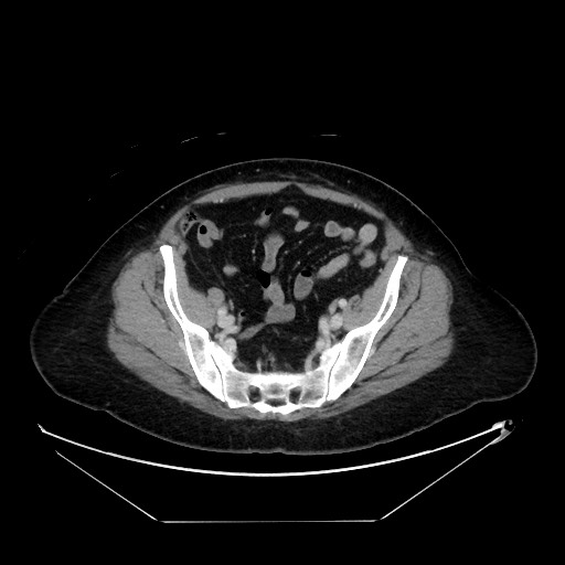 File:Breast cancer pseudocirrhosis with lobar invovlement (Radiopaedia 81080-94670 A 125).jpg
