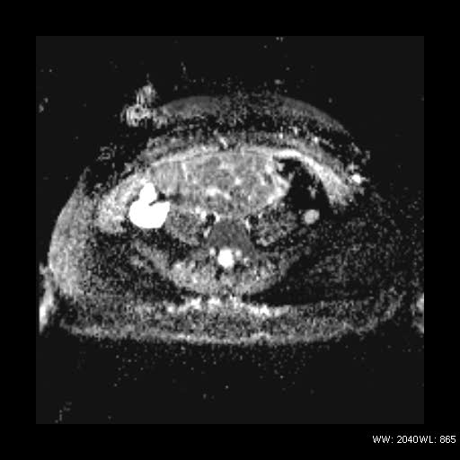 File:Broad ligament fibroid (Radiopaedia 49135-54241 Axial ADC 7).jpg