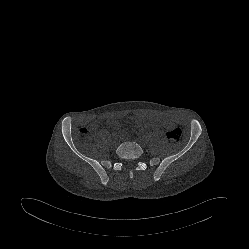 Brodie abscess- femoral neck (Radiopaedia 53862-59966 Axial bone window 20).jpg