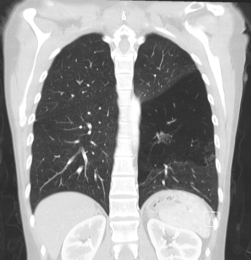 File:Bronchial atresia (Radiopaedia 73677-84470 Coronal lung window 24).jpg