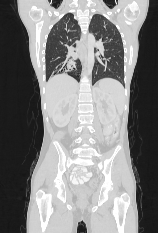 Bronchial carcinoid tumor (Radiopaedia 57187-64090 Coronal lung window 69).jpg