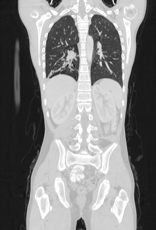 Bronchial carcinoid tumor (Radiopaedia 57187-64090 Coronal lung window 77).jpg