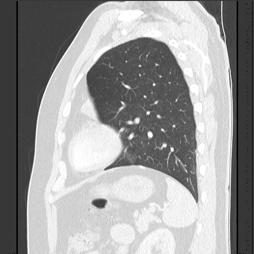 Bronchial carcinoid tumor (Radiopaedia 67377-76764 Sagittal lung window 52).jpg