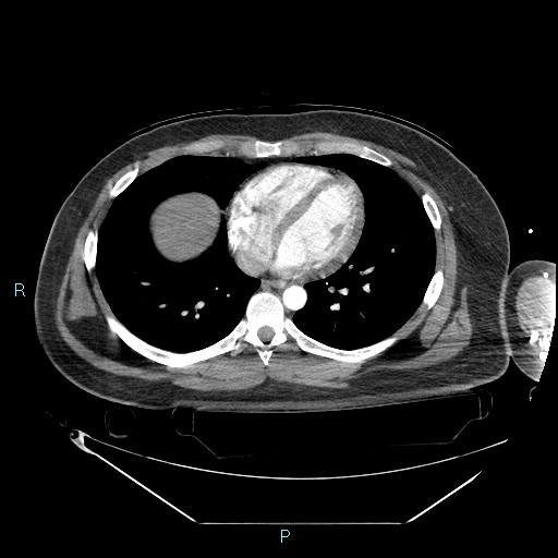 Bronchial carcinoid tumor (Radiopaedia 78272-90870 B 79).jpg