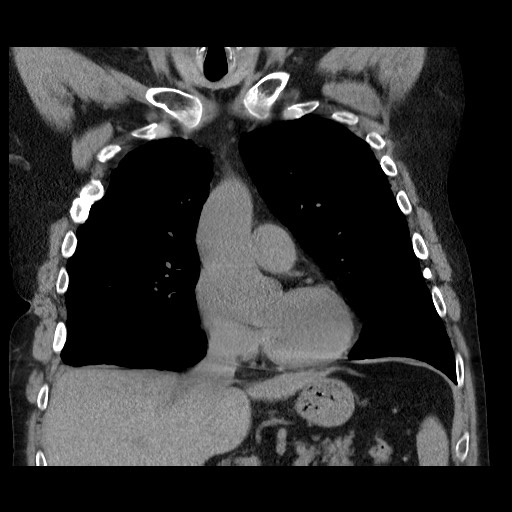 Bronchial stenosis - lung transplant (Radiopaedia 73133-83848 Coronal non-contrast 29).jpg