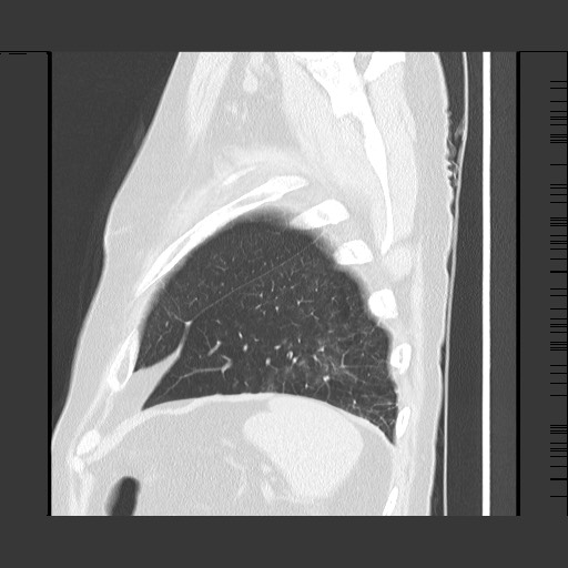 Bronchial stenosis - lung transplant (Radiopaedia 73133-83848 Sagittal lung window 60).jpg