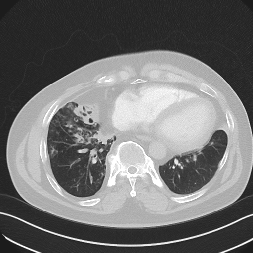 File:Bronchiectasis (Radiopaedia 39385-41666 Axial lung window 45).png