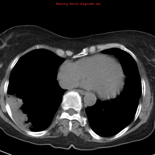 File:Bronchoalveolar carcinoma (BAC) (Radiopaedia 13436-13392 Axial non-contrast 36).jpg
