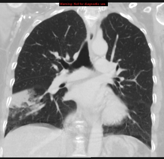 Bronchoalveolar carcinoma (BAC) (Radiopaedia 13436-13392 Coronal lung window 31).jpg