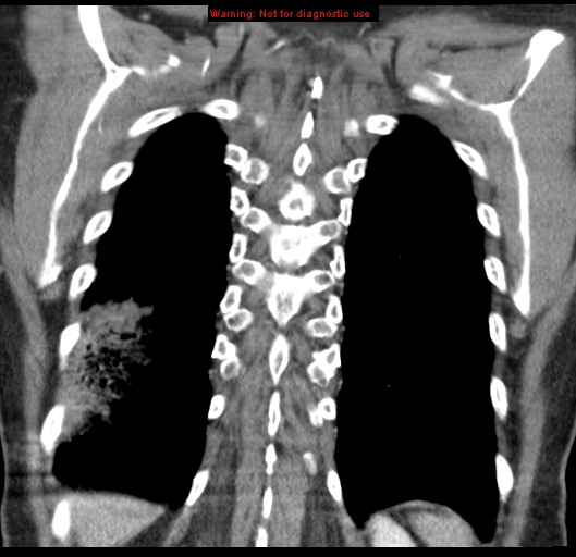 Bronchoalveolar carcinoma (BAC) (Radiopaedia 13436-13392 E 50).jpg