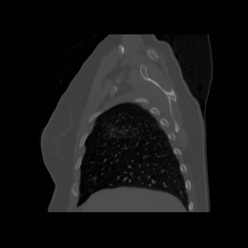 Bronchogenic carcinoma (Radiopaedia 73497-84262 Sagittal bone window 39).jpg