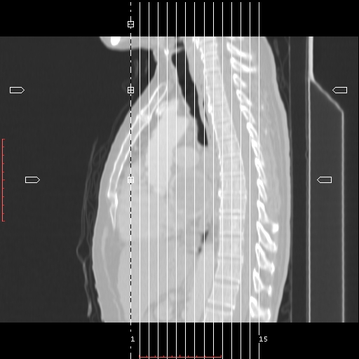 File:Bronchogenic carcinoma with left atrial large deposit - T4N3M1a (Radiopaedia 42316-45428 Coronal lung window 1).jpg