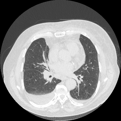 Bronchogenic carcinoma with metastatic lymphadenopathy (Radiopaedia 37671-39569 Axial lung window 32).jpg