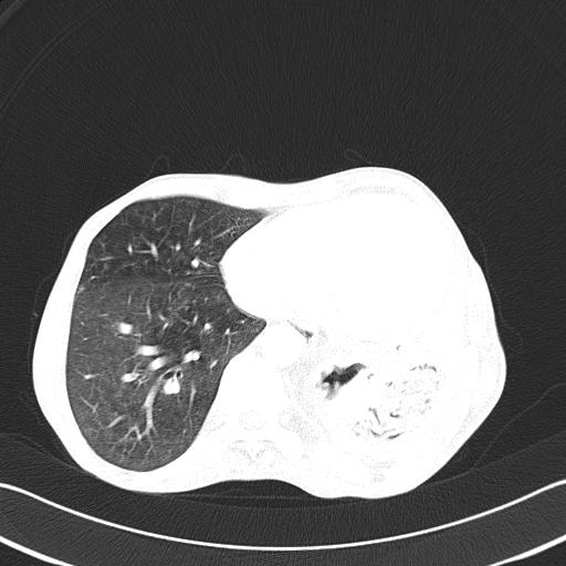 File:Bronchopleural fistula secondary to tuberculosis (Radiopaedia 20415-20322 Axial lung window 41).jpg