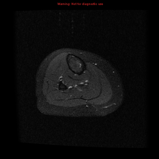 File:Brown tumor (Radiopaedia 12318-12597 Axial T1 C+ fat sat 26).jpg