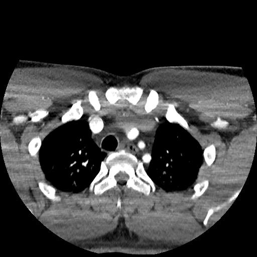 Buccal fat pad arteriovenous malformation (Radiopaedia 70936-81144 D 11).jpg