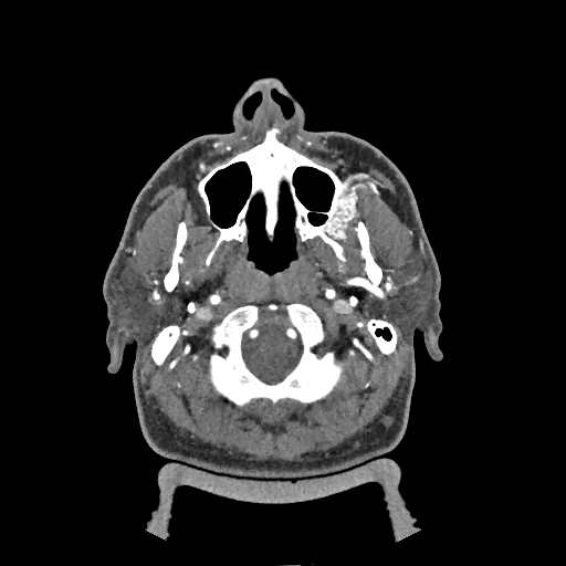 Buccal fat pad arteriovenous malformation (Radiopaedia 70936-81144 D 224).jpg