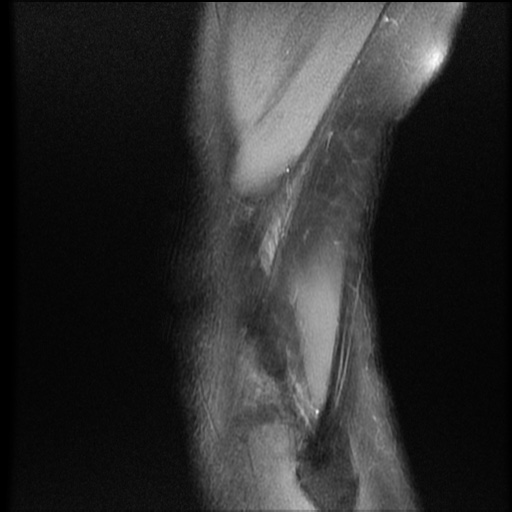 File:Bucket-handle meniscus tear (Radiopaedia 65700-74809 Sagittal PD fat sat 21).jpg