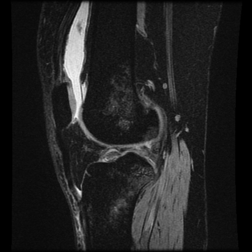 Bucket handle meniscus tear (Radiopaedia 56916-63751 H 32).jpg