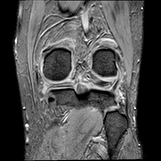 File:Bucket handle tear - medial meniscus (Radiopaedia 29250-29664 B 16).jpg