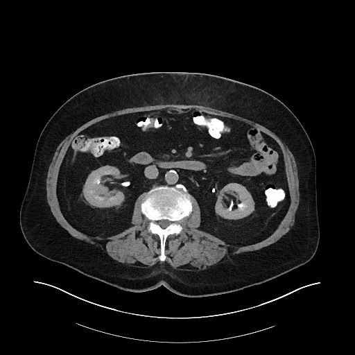 File:Buried bumper syndrome - gastrostomy tube (Radiopaedia 63843-72575 Axial Inject 19).jpg