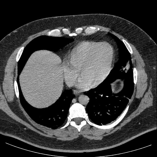 File:Burned-out testicular seminoma - retroperitoneal nodal metastases (Radiopaedia 62872-71245 A 6).jpg