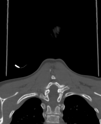 Butterfly vertebra (Radiopaedia 77903-90209 Coronal bone window 81).jpg
