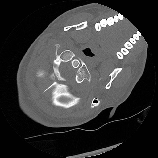 C1-C2 "subluxation" - normal cervical anatomy at maximum head rotation (Radiopaedia 42483-45607 Axial non-contrast 52).jpg