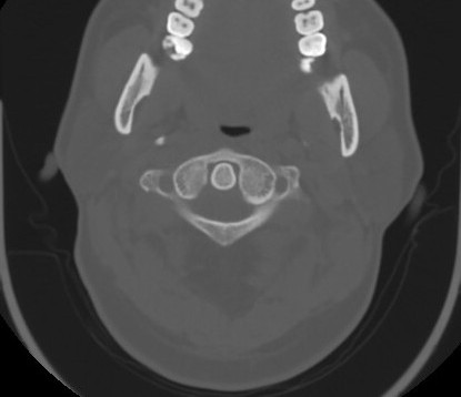 C7 laminar fracture and Klippel-Feil syndrome (Radiopaedia 86710-102850 Axial bone window 25).jpg