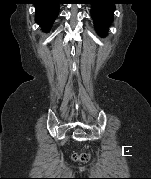 Calcified adrenal glands and Spigelian hernia (Radiopaedia 49741-54988 B 105).jpg