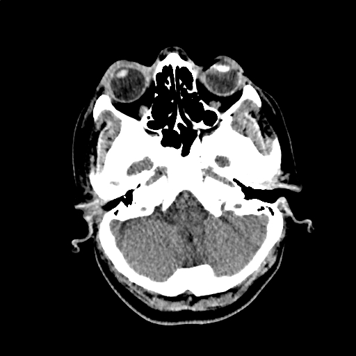 Calcified cerebral hydatid cyst (Radiopaedia 65603-74717 Axial non-contrast 6).jpg