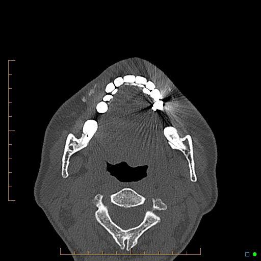 Calcified facial augmentation fillers (Radiopaedia 79514-92679 Axial bone window 111).jpg