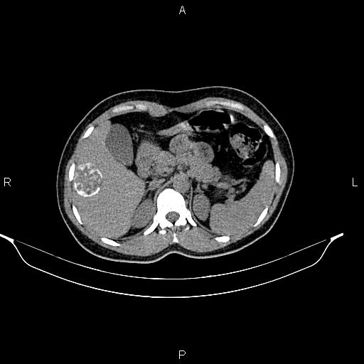 File:Calcified hepatic hydatid cyst (Radiopaedia 84672-100095 Axial non-contrast 30).jpg