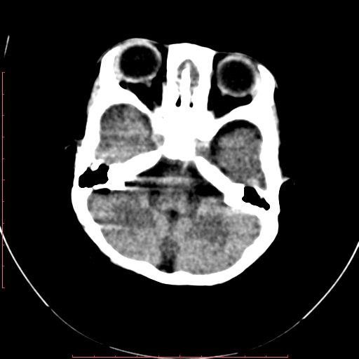 File:Calcified middle cerebral artery embolism (Radiopaedia 78949-91860 Axial non-contrast 6).jpg