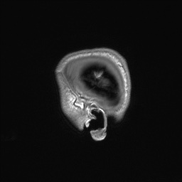 Callosal dysgenesis with interhemispheric cyst (Radiopaedia 53355-59335 Sagittal T1 166).jpg